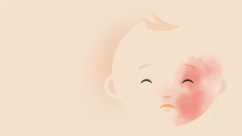 รู้จักกับโรคหายาก Sturge-Weber พบปานแดง ต้อหิน และชัก ต้องรักษาตลอดชีวิต