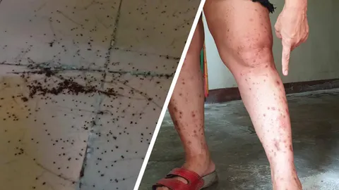 เห็บบุกห้อง บ้านเอื้ออาทร สาวลูกอ่อนถูกกัดเป็นแผลพุพอง