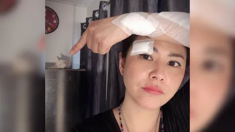 น้ำผึ้ง ณัฐริกา โชว์แผลหวิดเสียโฉม เป็นกรรมการห้ามแมวต้องเย็บ 3 เข็ม 