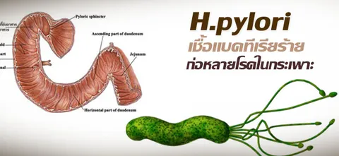 H.pylori เชื้อแบคทีเรียร้ายก่อหลายโรคในกระเพาะ