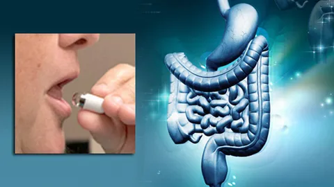 แคปซูลตรวจจับ “ตด” วินิจฉัยโรคลำไส้