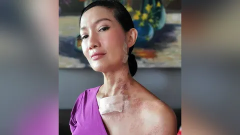 ดี้ ชนานา เผยชีวิตหลังเป็นงูสวัด เตือนคนรุ่นใหญ่ นอนไม่พอ ระวังไวรัส