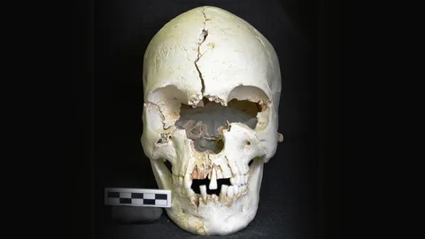 กะโหลกบนเกาะในแคริบเบียน ให้หลักฐานโรคเรื้อน