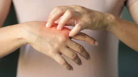 รู้จัก "โรคเชื้อรา" รักษาอย่างไร ไม่ให้กลับมาเป็นอีก