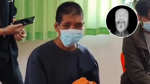 ทนายเกิดผล เผยภาพ X-Ray "น้องฟ้า" เหยื่อนายจ้างโหด กระดูกแตกหักทั่วร่าง