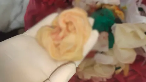 เสริมหน้าอกสยอง สาวเล่าอุทาหรณ์ หมอลืมผ้าก๊อซจนแผลอักเสบ หนองทะลัก