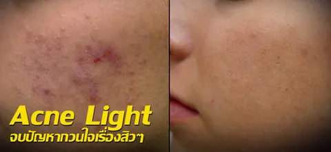 Acne Light  จบปัญหากวนใจเรื่องสิวๆ