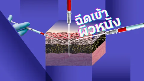 เปรียบเทียบผลข้างเคียงฉีดวัคซีนโควิดเข้าชั้นผิวหนัง กับกล้ามเนื้อ แบบไหนน้อยกว่า