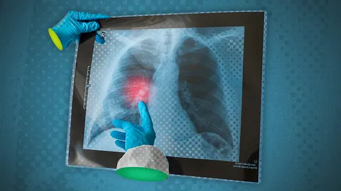 สัญญาณเตือน "มะเร็งปอด" ภัยร้ายคร่าชีวิต เช็กปัจจัยเสี่ยง แนะวิธีการรักษา