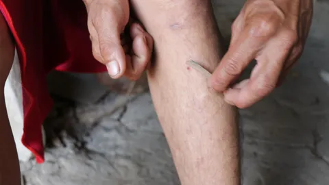 สุดสะพรึง ฝูงปลิงรุมกัดขา เข้าก้นชายวัย 41 ปี โชคดีใช้มือดึงออกมาทัน