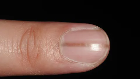 วิธีสังเกต "มะเร็งผิวหนังในเล็บ" พบมีแถบสีน้ำตาลแบบไหนควรไปพบแพทย์