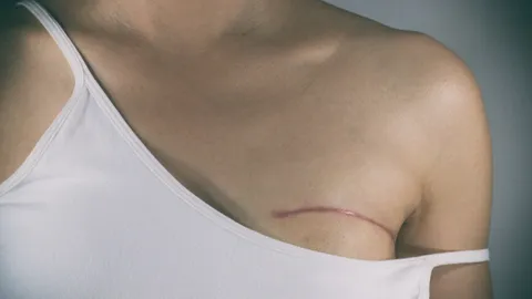 ศัลยกรรมหน้าอก ยกกระชับหน้าอก (Breast Lift) และลดขนาดหน้าอก (Breast Reduction)