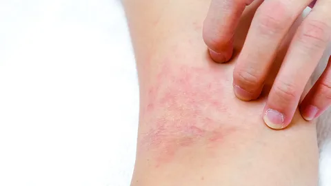 แนะควรหลีกเลี่ยงปัจจัยกระตุ้นแพ้อาหาร