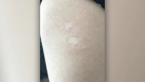 รีบดูแขนตัวเอง หมอธีระวัฒน์ เผยภาพแผลเป็นแบบไหนป้องกัน "ฝีดาษลิง" ได้