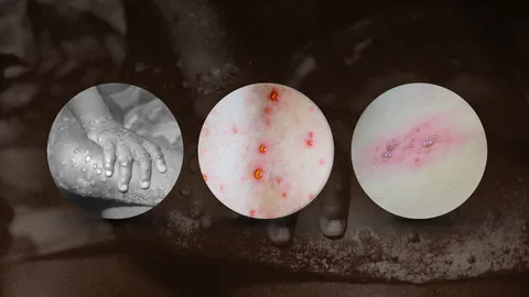 เทียบอาการทางผิวหนัง "โรคฝีดาษลิง" กับ "โรคติดต่อจากเชื้อไวรัส" ต่างกันอย่างไร