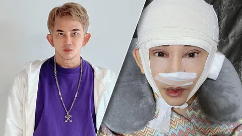 พชร์ อานนท์ โพสต์ภาพหลังศัลยกรรม ชอบมากหน้าเด็กลง 20 ปี ไม่แคร์คนบูลลี่