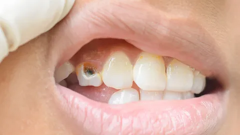 พบเด็กไทยฟันผุ-ผู้ใหญ่เหงือกอักเสบ คนเข้าถึงบริการทันตกรรมแค่ร้อยละ 10