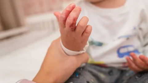 รู้จัก อาการและวิธีรักษา "โรคมือเท้าปาก" โรคยอดฮิตมาพร้อมฝน