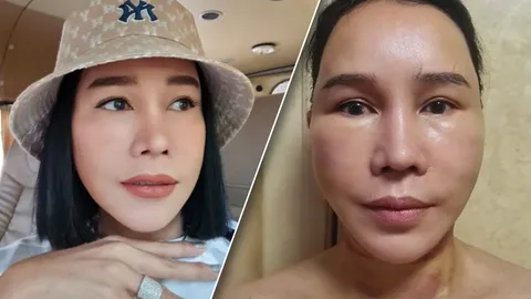 ส้มเช้ง สามช่า อัปเดตภาพล่าสุดหลังศัลยกรรมหน้า จ่ายเกือบ 4 แสนบาท (คลิป)