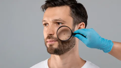 ไฝเสน่ห์ หรือ มะเร็งผิวหนัง