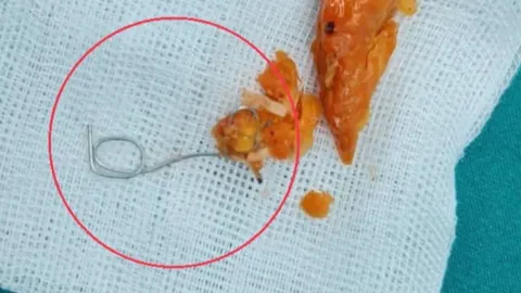 ต้องผ่าตัด เด็ก 8 ขวบ เจ็บคอ ร้องไม่หยุด เอกซเรย์พบ "ลวด" มัดไก่ย่าง ฝังหลอดอาหาร