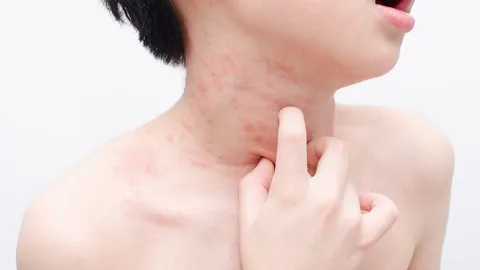 สารพันปัญหาผื่นในเด็ก