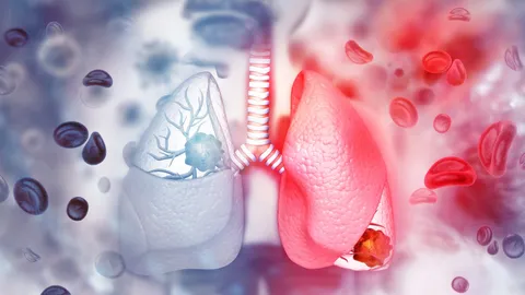 ระวัง 5 ปัจจัยเสี่ยง ไม่สูบบุหรี่ก็เป็นมะเร็งปอดได้!!