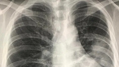 ปวดฟันอย่าปล่อยไว้ เชื้ออาจลุกลาม สุดท้ายกลายเป็น "โรคฝีในปอด"