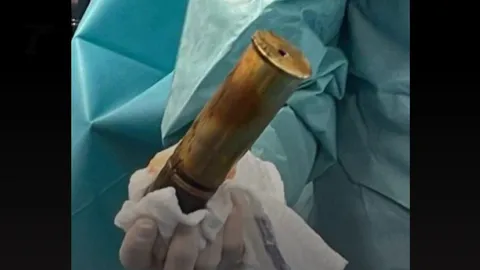 แตกตื่น หมอฝรั่งเศสเจอกระสุนปืนใหญ่ยุคสงครามโลก 1 ในทวารเฒ่าวัย 88 ปี