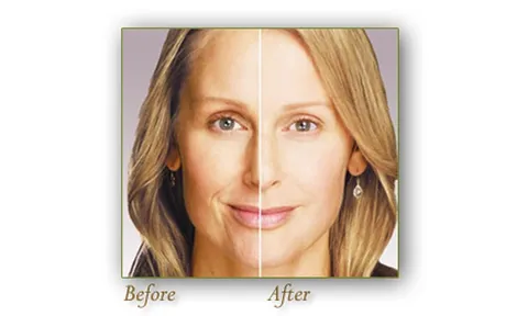 Filler Injection 'เติม' ให้เต็มด้วยสารกระชากวัย