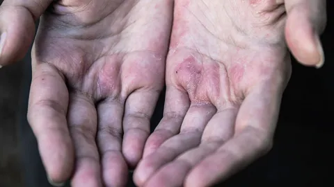 8 โรคผิวหนังผู้สูงอายุที่พบบ่อย เรื่องผิวๆ ของผู้สูงวัย