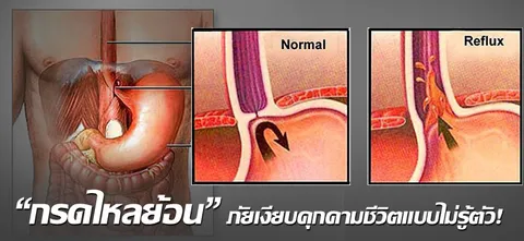 “กรดไหลย้อน” ภัยเงียบคุกคามชีวิตแบบไม่รู้ตัว!