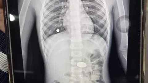 แม่เล่าอุทาหรณ์ ลูกชายอมเหรียญ 5 แล้วพลาดลงคอ เอกซเรย์พบอยู่ในหลอดอาหาร