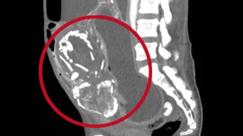 อึ้ง หญิงวัย 50 ขาดสารอาหารจนตายในสหรัฐฯ หลังมี 'ทารกหิน' ในท้อง 9 ปี