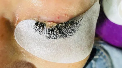 อุทาหรณ์ สาวโร่ถอดขนตาปลอม หลังช่างใช้กาวไม่ได้มาตรฐาน ติดขนตาจนเป็นก้อน