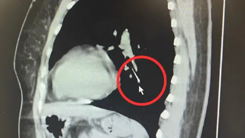 "คาบเข็มหมุด" ขณะเย็บผ้า เกิดสำลักลงหลอดลม แพทย์ต้องช่วยคีบออก