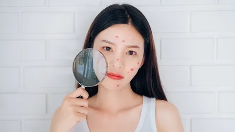 ทำนายฝันว่าสิวขึ้นเต็มหน้า มีความหมายอย่างไร ต้องระวังเรื่องใดบ้าง