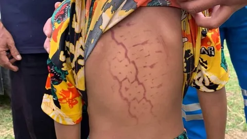 ปลอดภัยแล้ว เด็กชายวัย 5 ขวบ ถูกรถกระบะถอยทับ จนเป็น "รอยล้อ" กลางหลัง