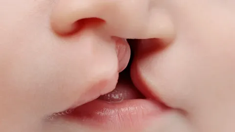 การแก้ไข “ภาวะปากแหว่งเพดานโหว่”