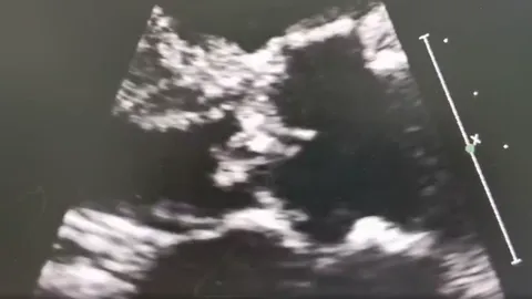 ไม่ใช่เรื่องเล่นๆ ผู้ป่วยติดเชื้อ "ไข้หูดับ" ลามถึงลิ้นหัวใจ ต้องใส่ท่อช่วยชีวิต