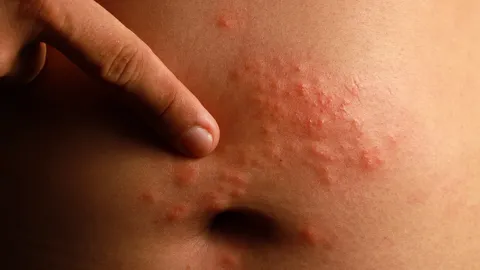 "อีสุกอีใส" พบในเด็กไข้สูงรีบพบแพทย์