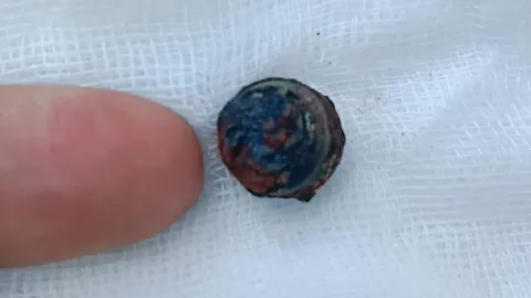 อุทาหรณ์ คิดว่าลูกเป็นภูมิแพ้มาตลอด 2 ปี สุดท้ายพบ "ถ่านของเล่น" ติดในโพรงจมูก