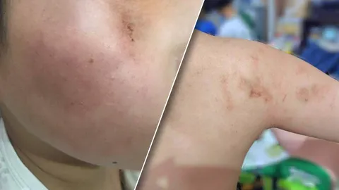 ครูสาว ตบเด็กพิเศษหน้าบวม หลังถูกถ่มน้ำลายใส่ ล่าสุดลาออกแล้ว 