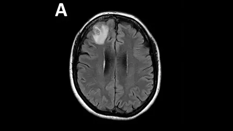 ออสเตรเลียพบ ‘พยาธิยังไม่ตาย’ ในสมองคนเป็นครั้งแรก