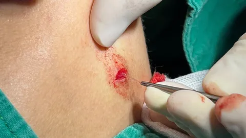 ภัยสายปลาก้างติดคอ 5 วัน เอกซเรย์ไม่พบ หมอต้องอัลตราซาวด์ผ่าตัดออก