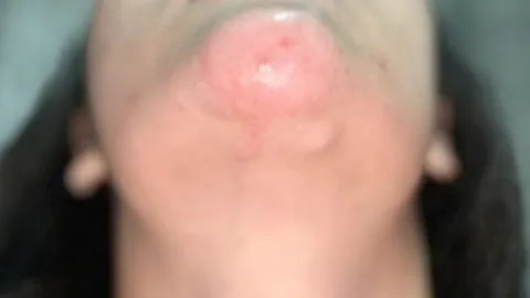 สาวเตือนภัย มือไม่สะอาดอย่าแกะเกา จากจุดเล็กๆ สู่แผลติดเชื้อ ถึงขั้นผ่าตัด