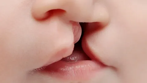 “CMU-Done พอดี” รักษาโรคปากแหว่งเพดานโหว่