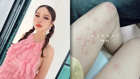 แอร์ ภัณฑิลา เครียดหลังคลอดลมพิษขึ้นขา แม่ๆ แห่คอมเมนต์แนะนำ