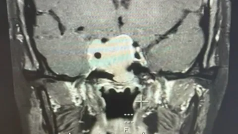 สาวเตือนภัย ประจำเดือนไม่มา สุดท้ายไปตรวจพบ "เนื้องอกต่อมใต้สมอง"