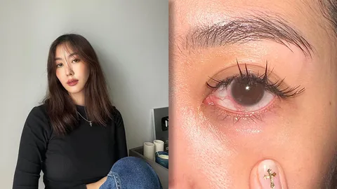 ยิปโซ เตือนเป็นอุทาหรณ์ ต่อขนตาแต่ได้แผลครูดและกระจกตาติดเชื้อ